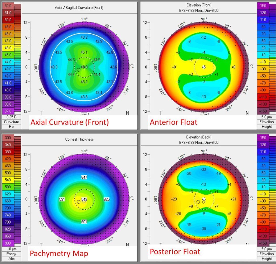 Topografía corneal